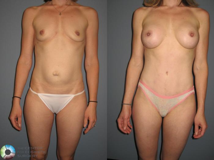 Before & After Tummy Tuck Case 877 View #2 View in Golden, CO