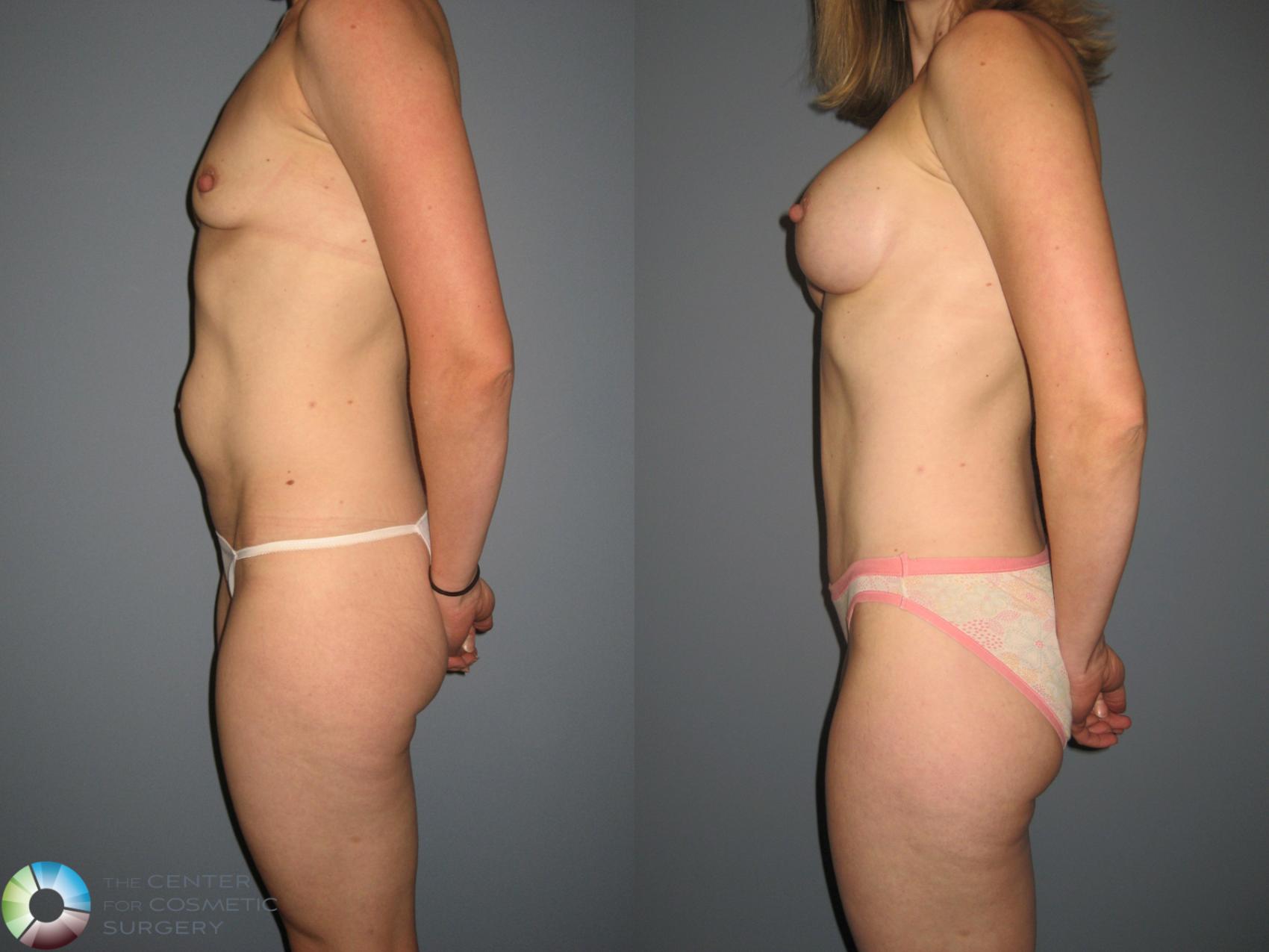 Before & After Tummy Tuck Case 877 View #3 in Denver and Colorado Springs, CO
