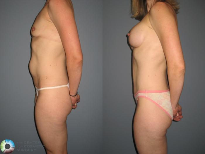 Before & After Tummy Tuck Case 877 View #3 View in Golden, CO