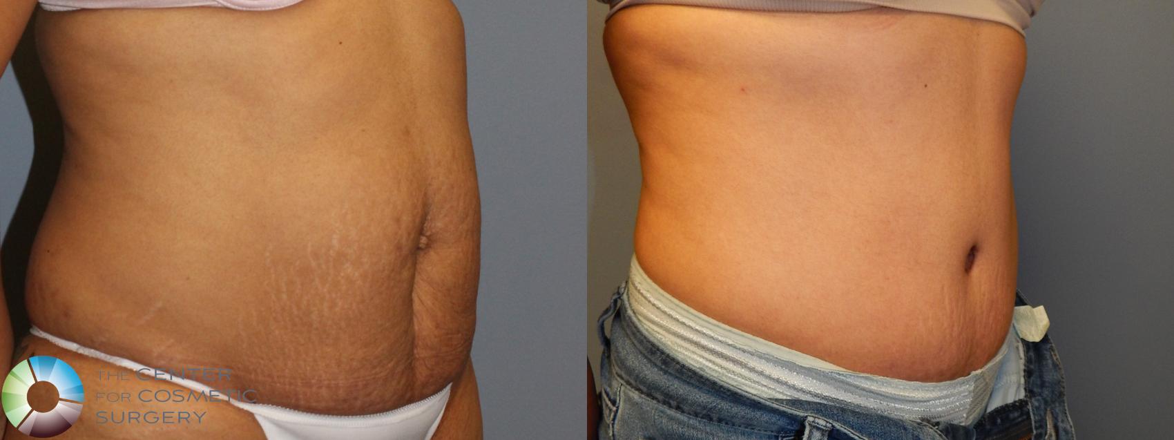 Before & After Tummy Tuck Case 883 View #1 in Denver and Colorado Springs, CO