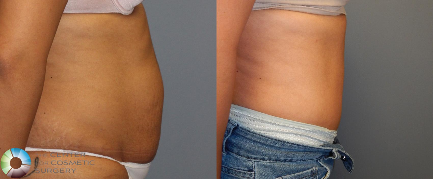 Before & After Tummy Tuck Case 883 View #2 View in Golden, CO