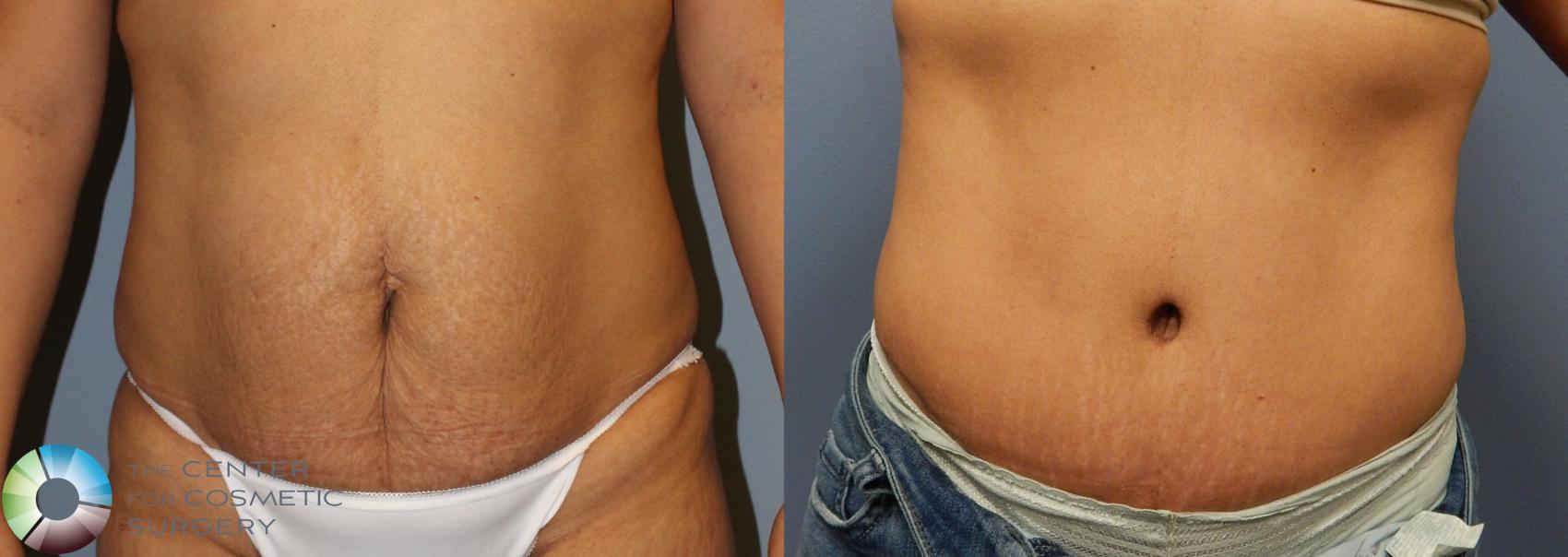 Before & After Tummy Tuck Case 883 View #3 View in Golden, CO
