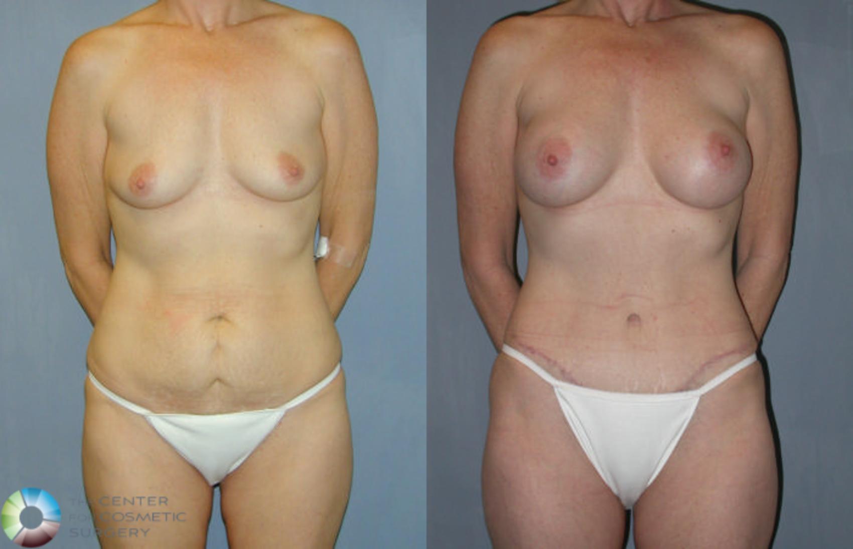 Before & After Tummy Tuck Case 9 View #1 in Denver and Colorado Springs, CO