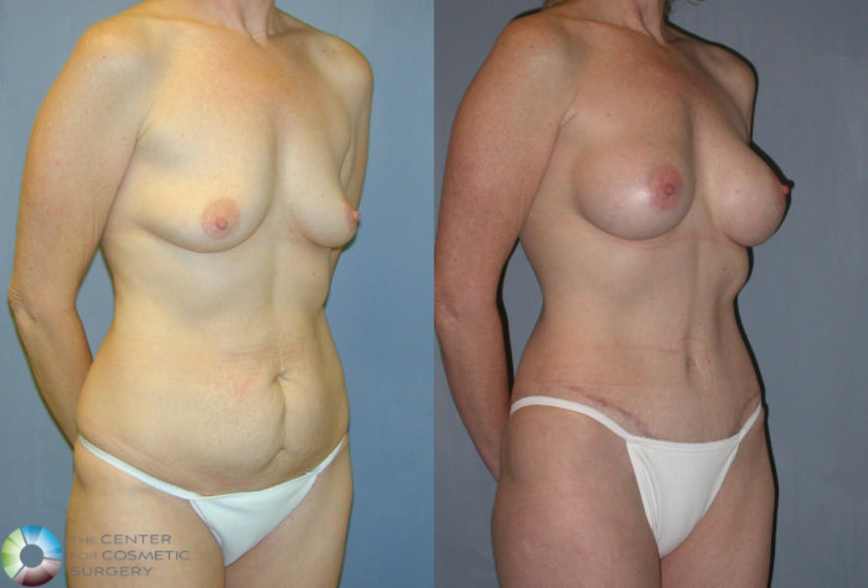 Before & After Tummy Tuck Case 9 View #2 in Denver and Colorado Springs, CO