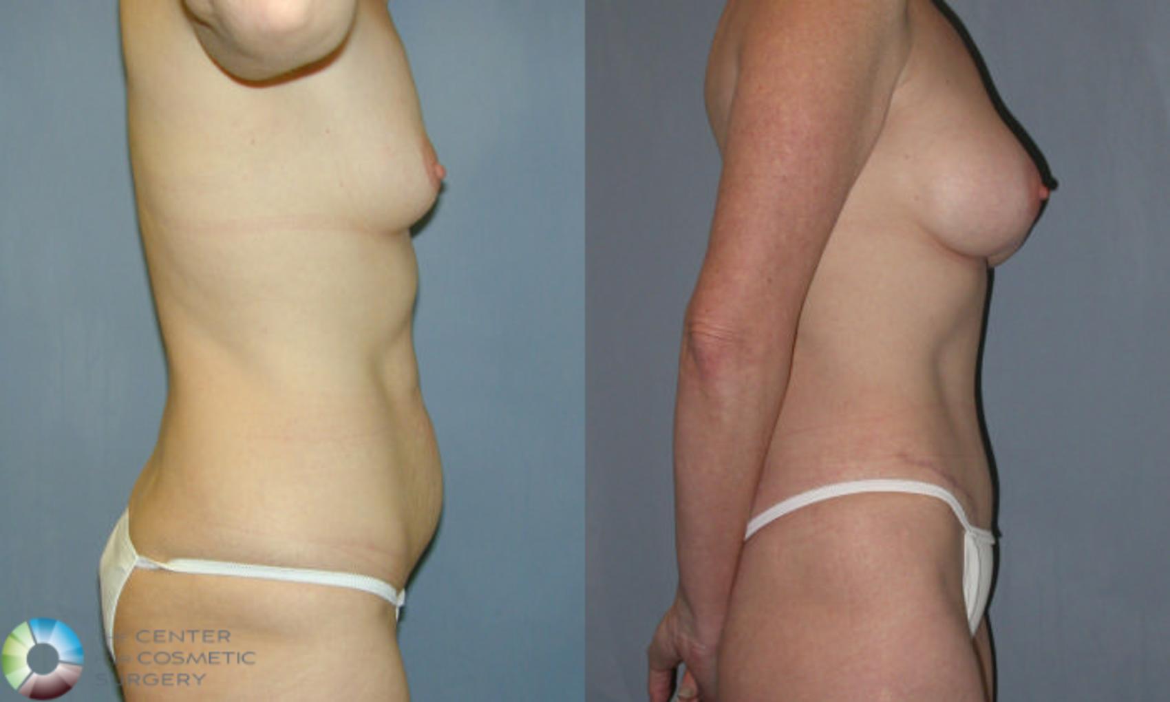 Before & After Tummy Tuck Case 9 View #3 in Denver and Colorado Springs, CO