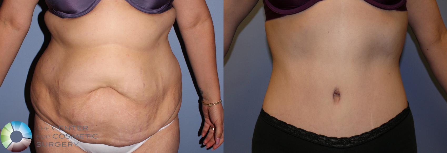 Before & After Tummy Tuck Case 903 View #1 View in Golden, CO