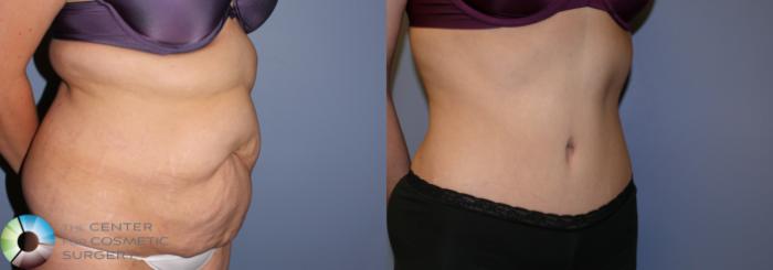 Before & After Tummy Tuck Case 903 View #2 View in Golden, CO