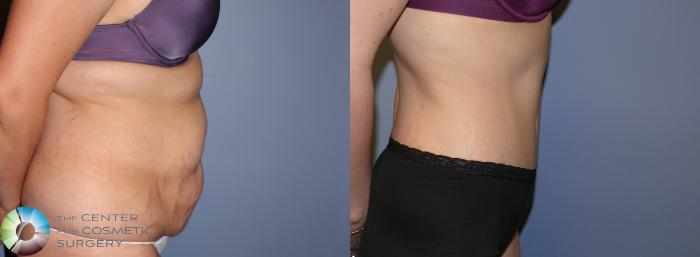 Before & After Tummy Tuck Case 903 View #3 View in Golden, CO