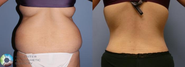 Before & After Tummy Tuck Case 903 View #4 View in Golden, CO