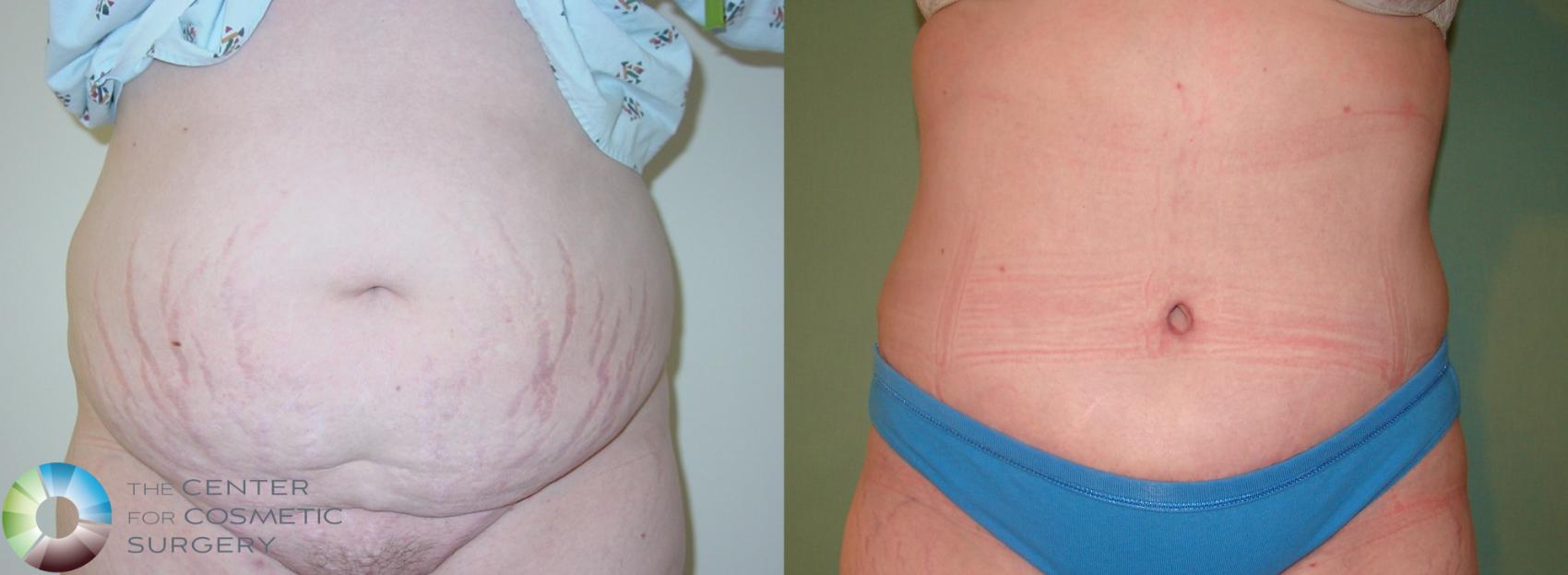 Before & After Tummy Tuck Case 906 View #1 in Denver and Colorado Springs, CO