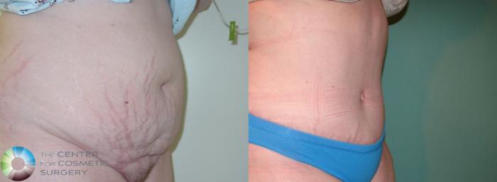 Before & After Tummy Tuck Case 906 View #2 View in Golden, CO