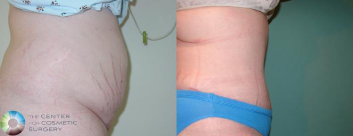 Before & After Tummy Tuck Case 906 View #3 View in Golden, CO