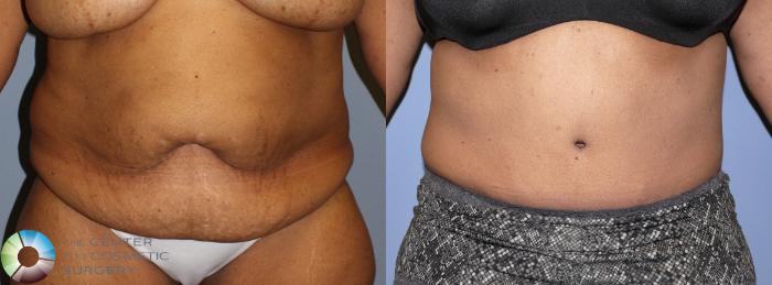 Before & After Tummy Tuck Case 923 View #1 in Denver and Colorado Springs, CO