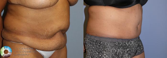 Before & After Tummy Tuck Case 923 View #2 in Denver and Colorado Springs, CO