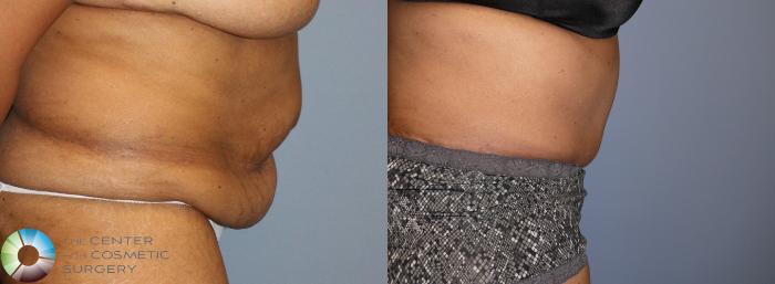 Before & After Tummy Tuck Case 923 View #3 in Denver and Colorado Springs, CO