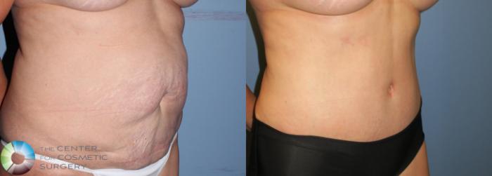 Before & After Tummy Tuck Case 941 View #1 View in Golden, CO