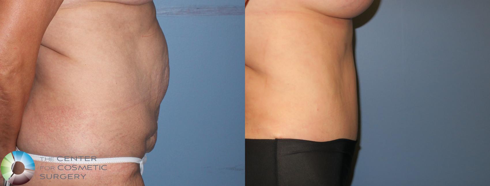 Before & After Tummy Tuck Case 941 View #2 in Denver and Colorado Springs, CO