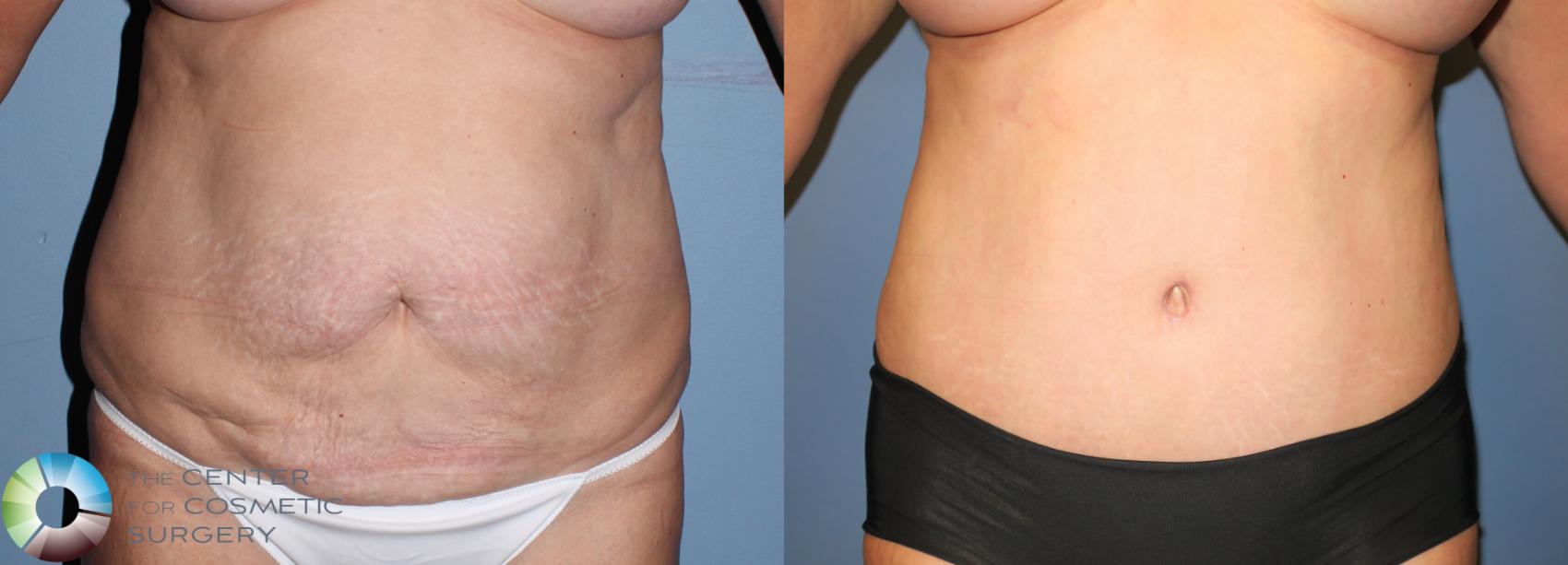 Before & After Tummy Tuck Case 941 View #3 in Denver and Colorado Springs, CO