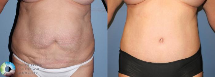 Before & After Tummy Tuck Case 941 View #3 View in Golden, CO