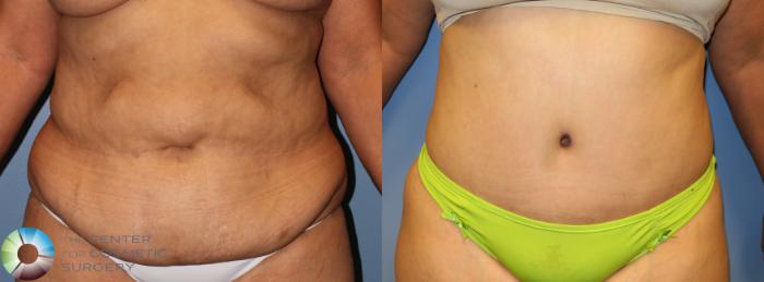 Before & After Tummy Tuck Case 945 View #1 in Denver and Colorado Springs, CO