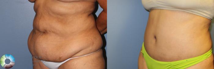 Before & After Tummy Tuck Case 945 View #2 in Denver and Colorado Springs, CO
