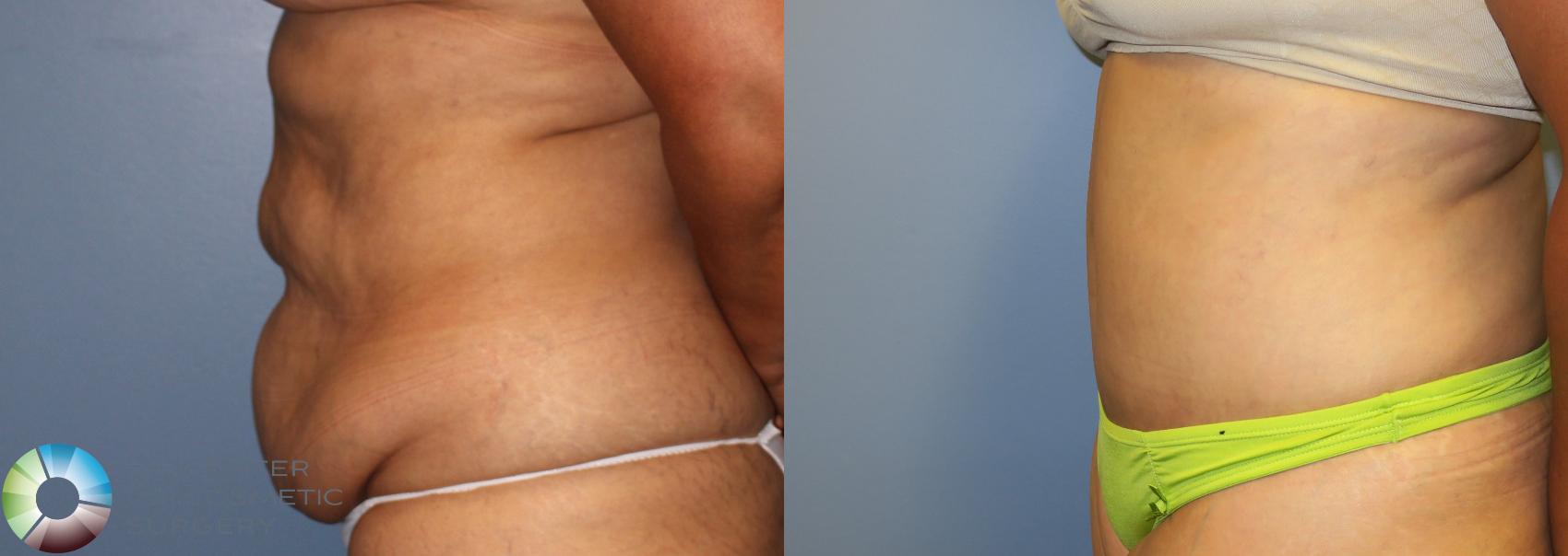 Before & After Tummy Tuck Case 945 View #3 View in Golden, CO