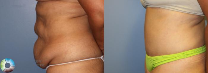 Before & After Tummy Tuck Case 945 View #3 in Denver and Colorado Springs, CO