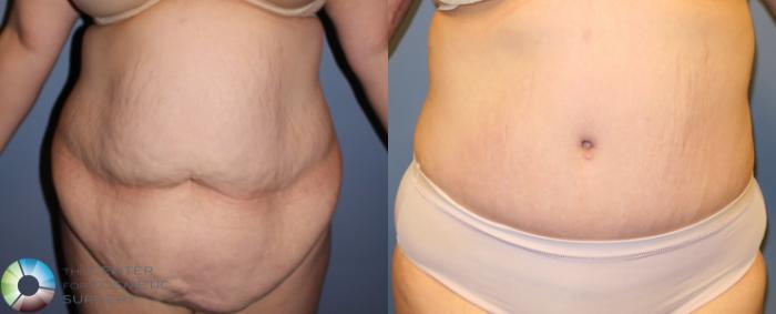 Before & After Tummy Tuck Case 946 View #1 View in Golden, CO