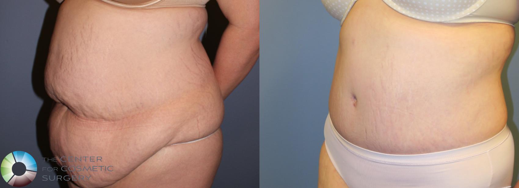 Before & After Tummy Tuck Case 946 View #2 in Denver and Colorado Springs, CO