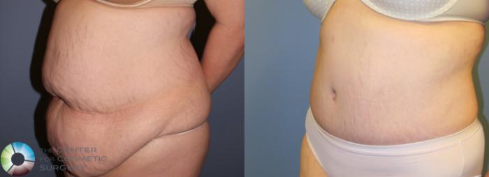Before & After Tummy Tuck Case 946 View #2 View in Golden, CO