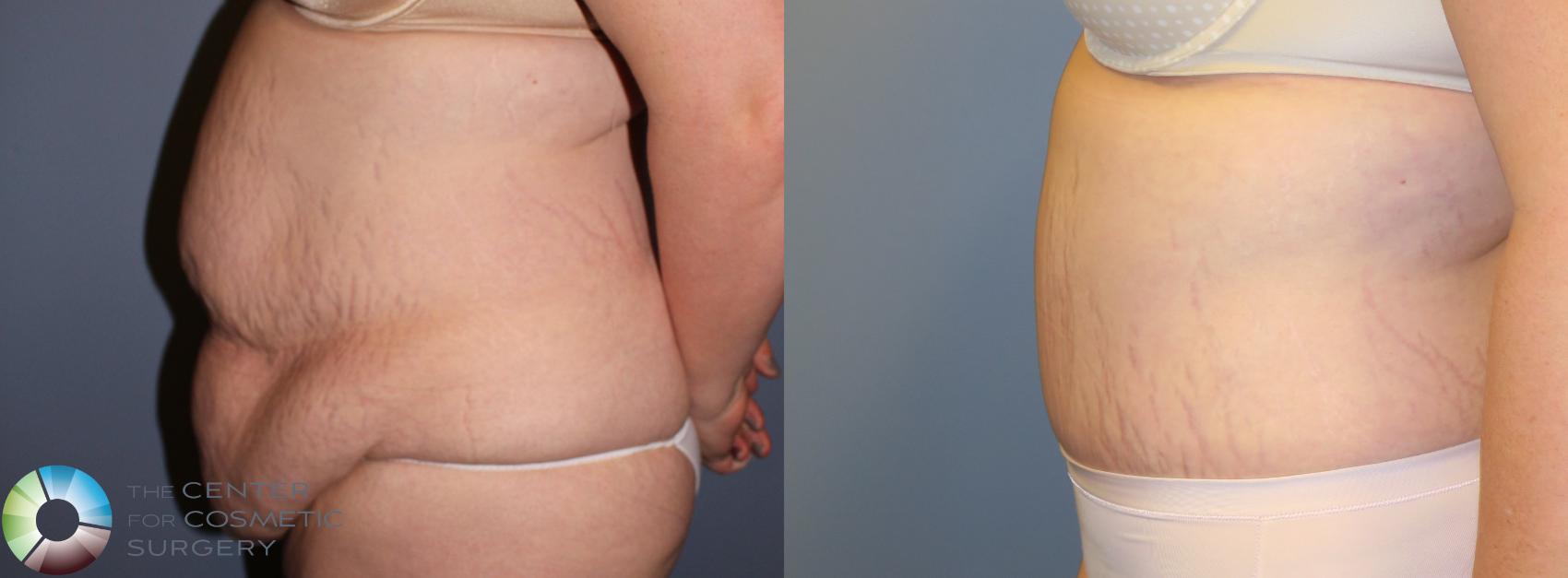 Before & After Tummy Tuck Case 946 View #3 in Denver and Colorado Springs, CO