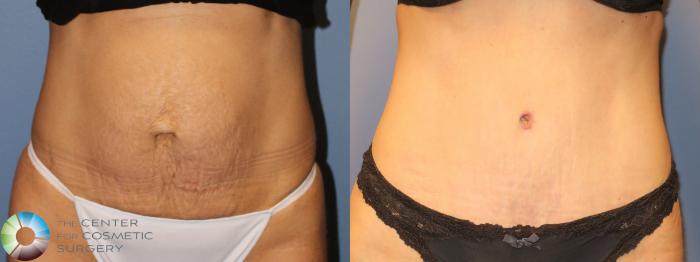 Before & After Tummy Tuck Case 947 Front View in Golden, CO