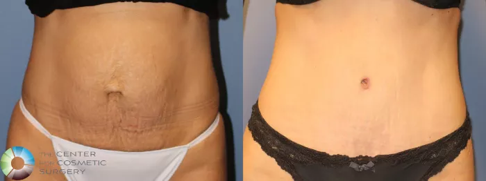 Tummy Tuck Before and After Pictures Case 947, Golden, CO