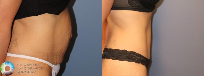 Before & After Tummy Tuck Case 947 Right Lateral View in Golden, CO