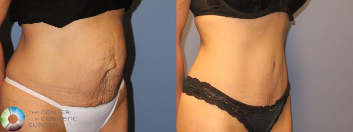 Before & After Tummy Tuck Case 947 Right Oblique View in Golden, CO