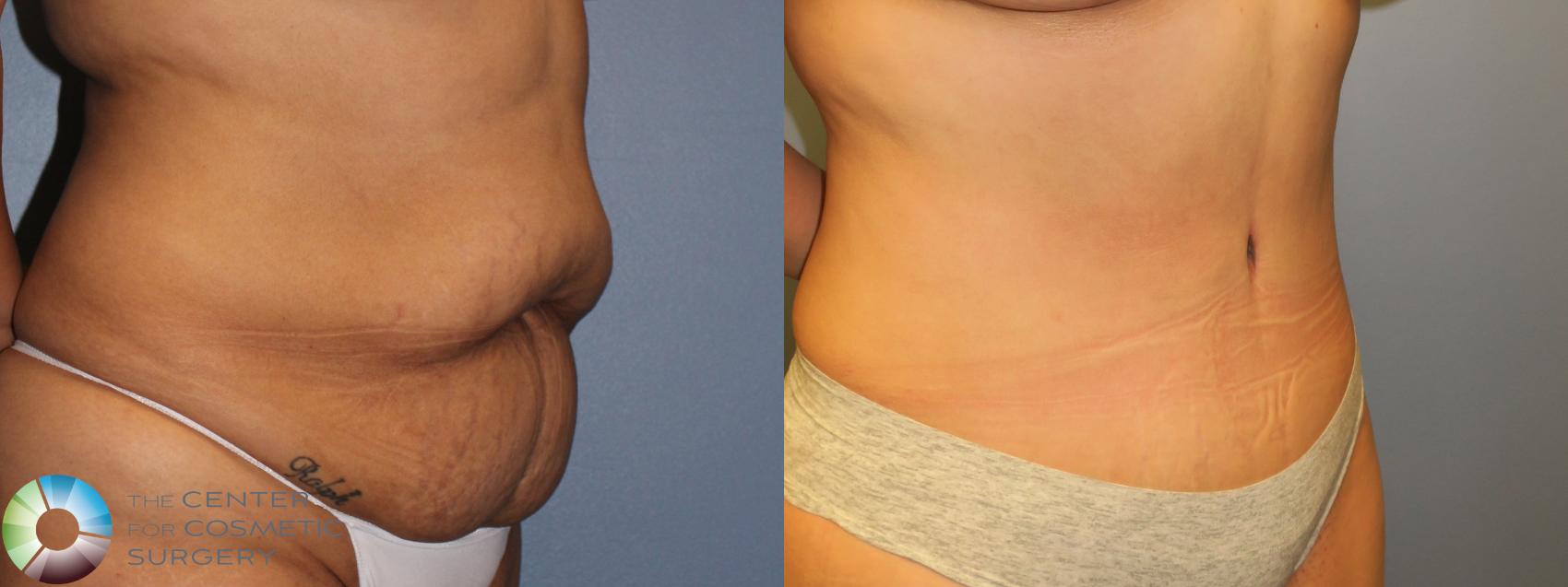 Abdominoplasty Overview: Cost, Recovery, Before & After