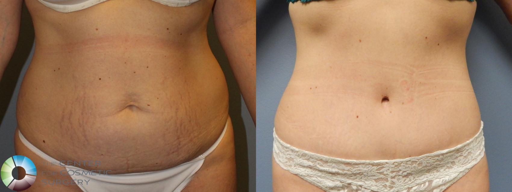 Mini Tuck And Tummy Tuck (abdominoplasty) Before & After Photos Patient 06