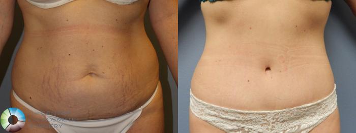 Before & After Tummy Tuck Case 950 Anterior View in Golden, CO