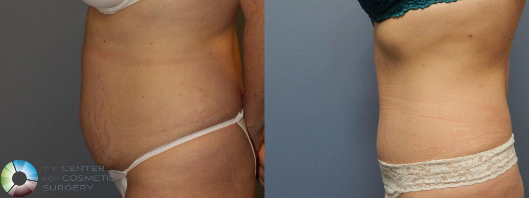 Before & After Tummy Tuck Case 950 Left Lateral in Denver and Colorado Springs, CO