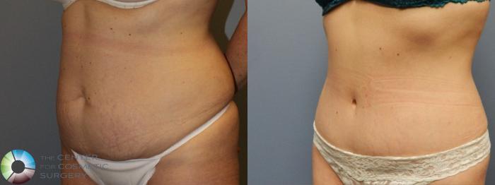 Before & After Tummy Tuck Case 950 Left Oblique View in Golden, CO