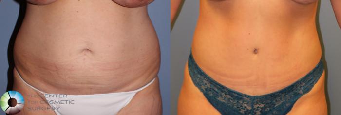 Before & After Tummy Tuck Case 951 View #1 View in Golden, CO