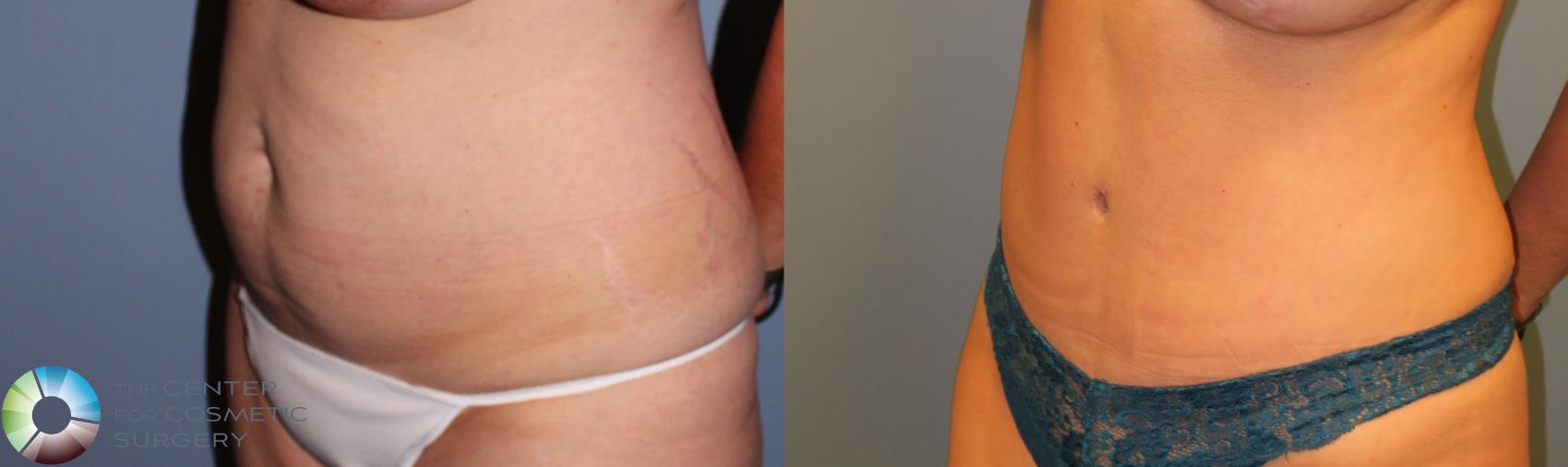 Before & After Tummy Tuck Case 951 View #2 in Denver and Colorado Springs, CO