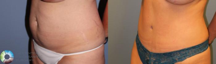 Before & After Tummy Tuck Case 951 View #2 View in Golden, CO