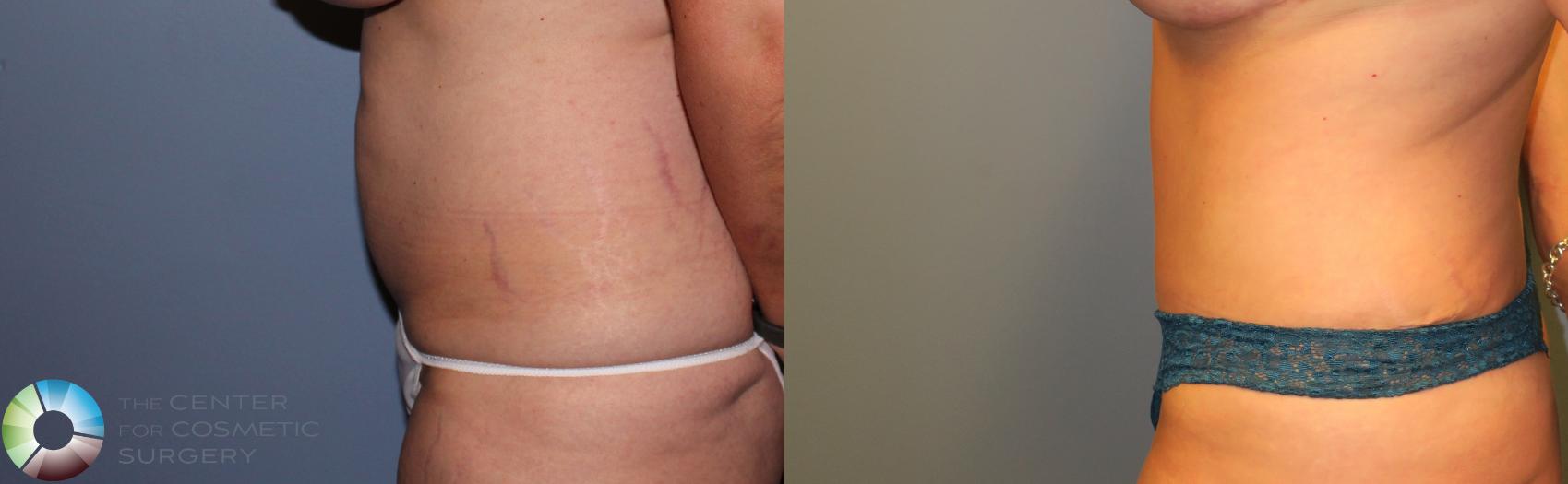 Before & After Tummy Tuck Case 951 View #3 in Denver and Colorado Springs, CO
