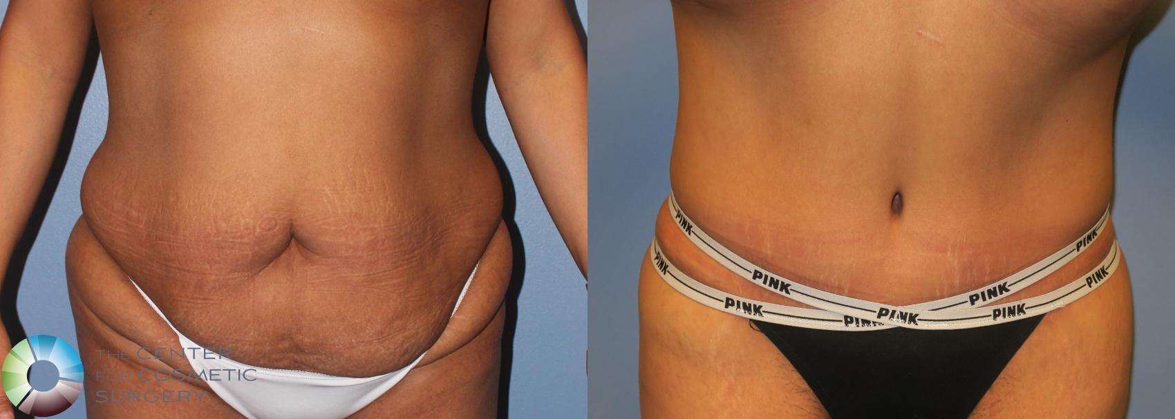 Before & After Tummy Tuck Case 953 View #1 View in Golden, CO