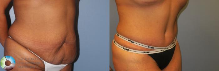 Before & After Tummy Tuck Case 953 View #2 in Denver, CO