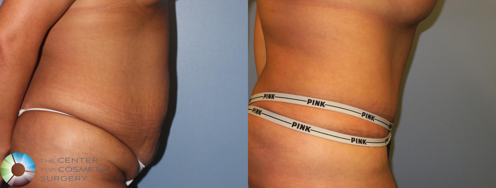 Before & After Tummy Tuck Case 953 View #3 View in Golden, CO