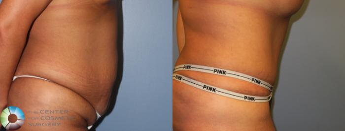 Before & After Tummy Tuck Case 953 View #3 in Denver, CO