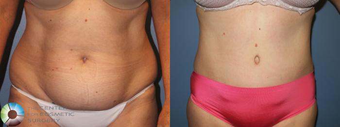 Before & After Tummy Tuck Case 954 Front in Denver and Colorado Springs, CO