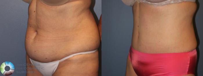 Before & After Tummy Tuck Case 954 Left oblique in Denver and Colorado Springs, CO